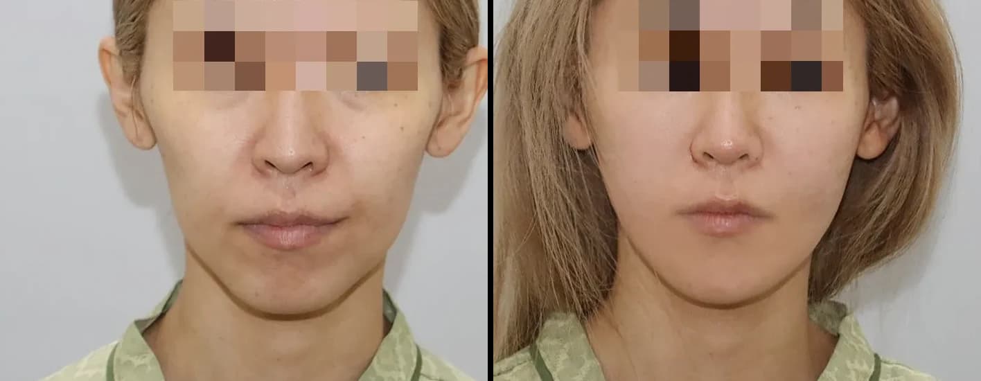 肌・美肌 Before & After — リストーリー整形外科