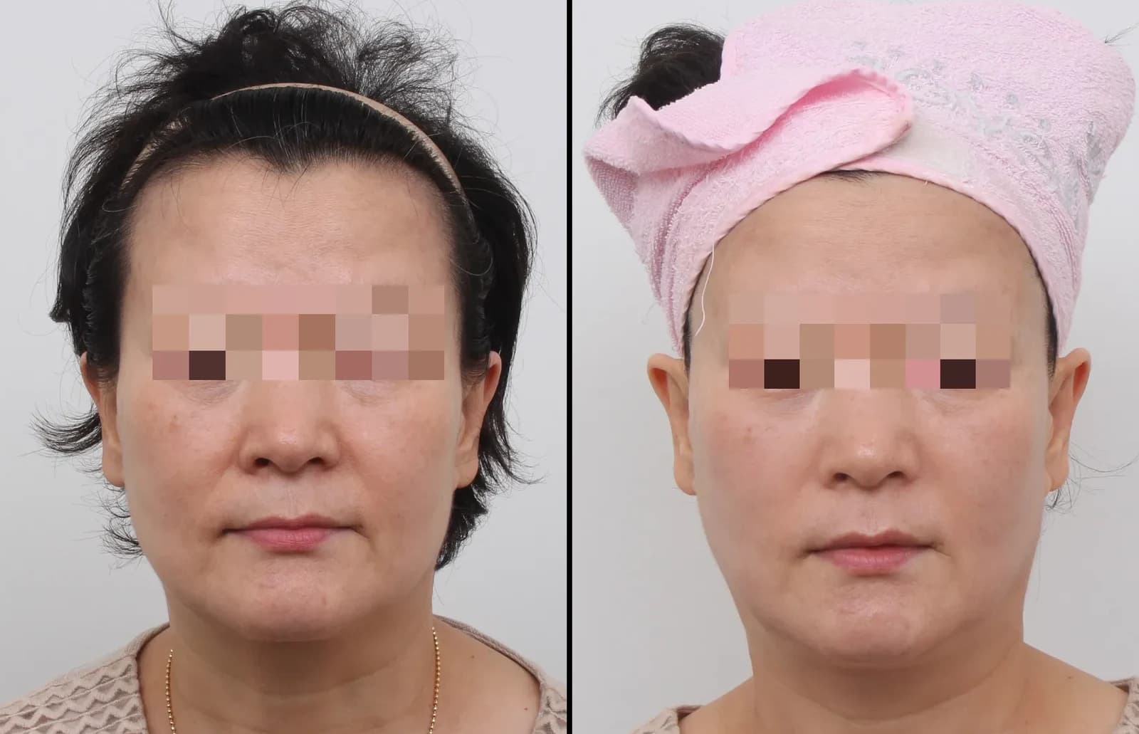 肌・美肌 Before & After — リストーリー整形外科