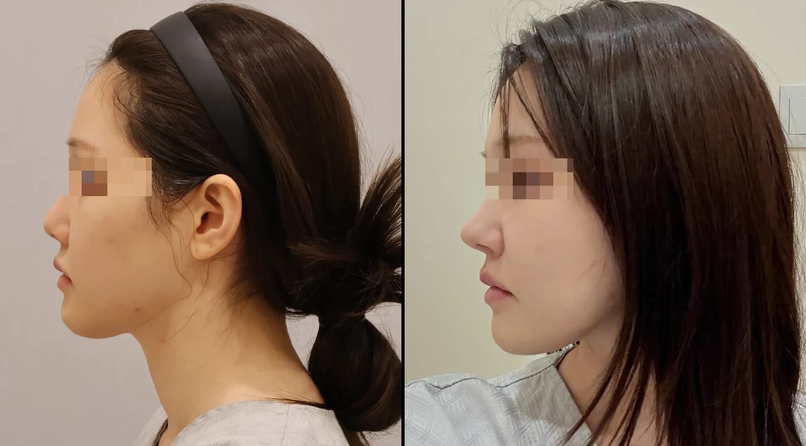 鼻 Before & After — リストーリー整形外科