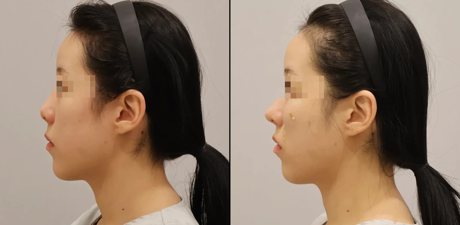 鼻 Before & After — リストーリー整形外科