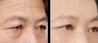 輪郭・額 Before & After — リストーリー整形外科